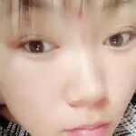 揪痧治咽炎